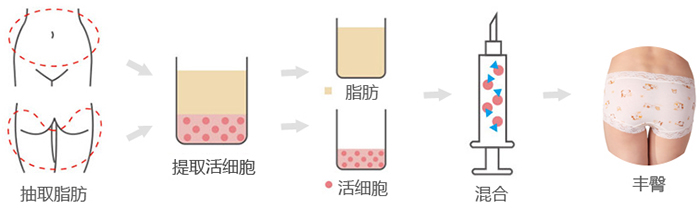 自體脂肪豐臀